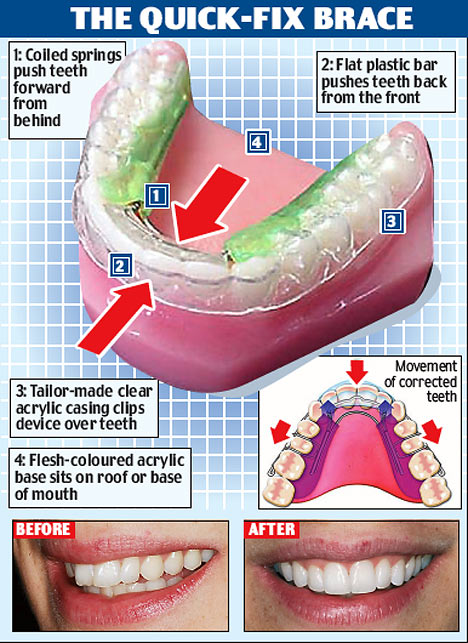 Aparelho dental revolucionário promete consertar sua boca em um mês! | Bizarro | bizarro, curioso, noticias