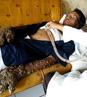 Raízes voltam a crescer no Homem Árvore 938194 8627 it2 | Bizarro | bizarro, curioso, doenças, horrível, medicina, mutante, nojento, sinistro