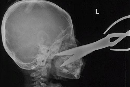 Top 10 espetinhos do Mundo Gump x ray showing the scissors impaled in four year old xiao yu s face pic rex features 282086105 | Animais | bizarro, curioso, empalamento, grotesco, mortes, notícia, sinistro