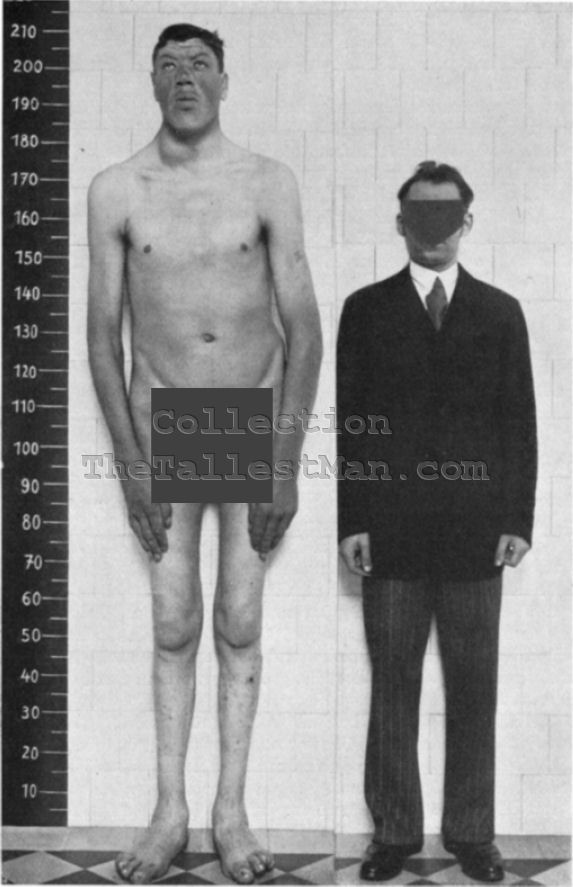 O inacreditável caso do anão que virou gigante adamrainer | Bizarro | absurdo, anão, bizarro, curioso, doenças, doido, estranho, gigante