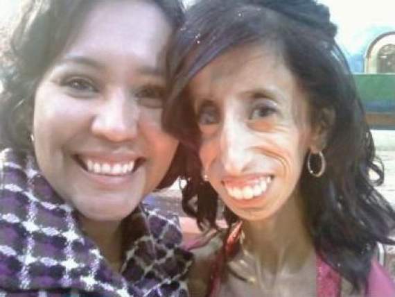 A mulher que precisa comer a cada 15 minutos para não morrer izzie10 | Bizarro | bizarro, doença, incrível, mutante, progeria, rara, sinistro