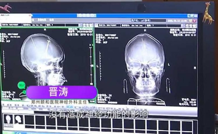 Mistério: Mulher descobre 2 agulhas enfiadas em seu cérebro e não sabe como elas foram parar lá brain needles2 750x462 1 | Bizarro | agulhas, bizarro, cerebro, china, sinistro, tomografia
