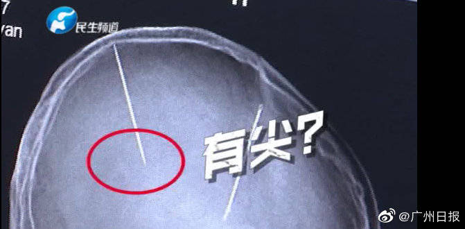Mistério: Mulher descobre 2 agulhas enfiadas em seu cérebro e não sabe como elas foram parar lá brain needles3 | Bizarro | agulhas, bizarro, cerebro, china, sinistro, tomografia