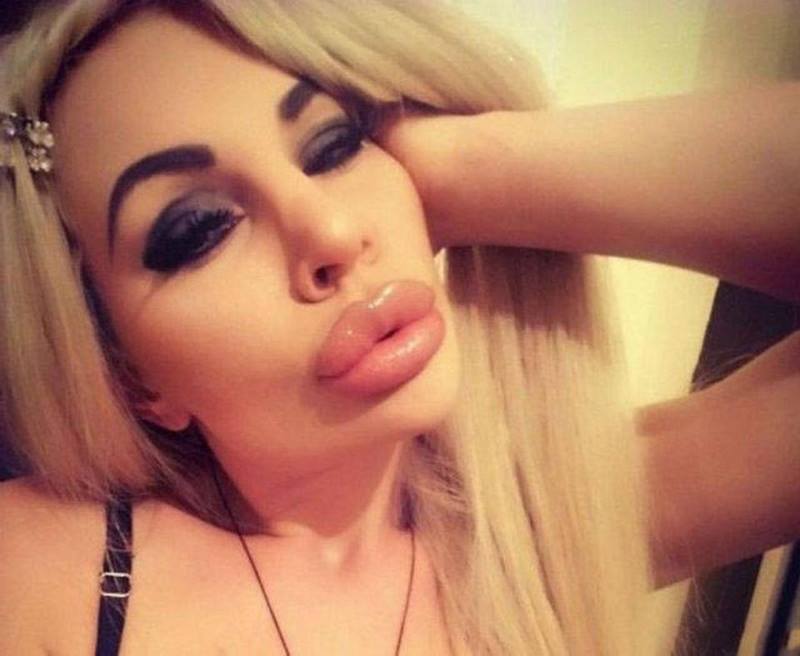 Beiço Monstro: Dez garotas que perderam completamente a noção 180119 27 | Bizarro | bizarro, desastre, horrível, plastica, sinistro