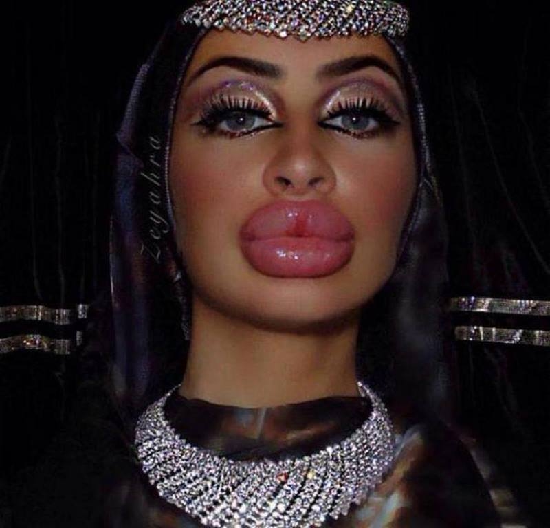Beiço Monstro: Dez garotas que perderam completamente a noção 180119 28 | Bizarro | bizarro, desastre, horrível, plastica, sinistro