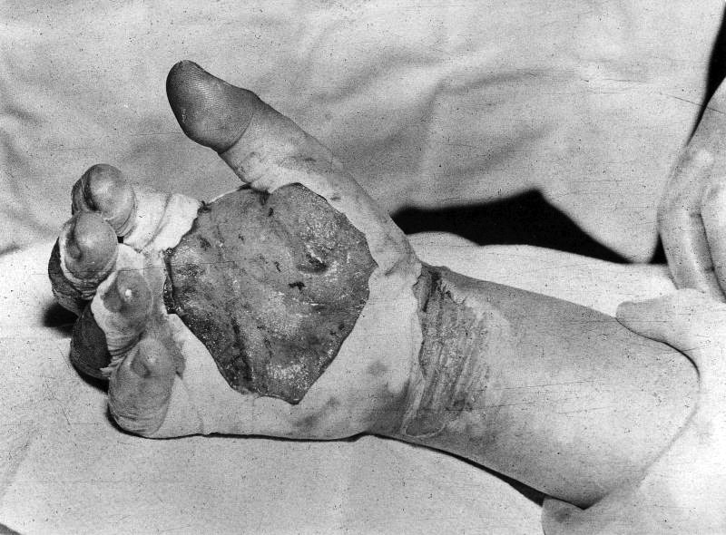 O acidente radioativo de Harry Daglian Daghlian hand | Curiosidades | ciência, curiosiddes, mortes, radioatividade, sinistro