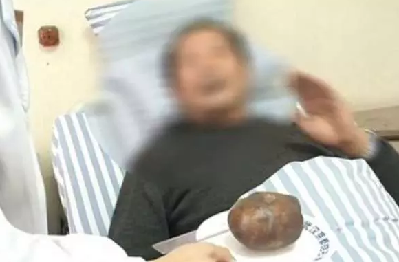 Sinistro: A pedra na bexiga Homem tem pedra do tamanho de um ovo de avestruz retirada da bexiga O TEMPO | Bizarro | bexiga, bizarro, doença, hospital, incrível, medico, pedra, rim