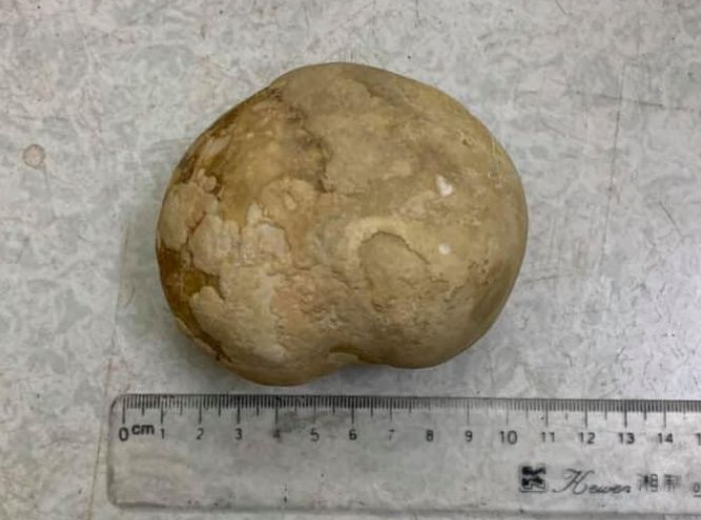 Sinistro: A pedra na bexiga Uma enorme pedra tirada da bexiga de um residente vietnamita Paranormal News 1 | Bizarro | bexiga, bizarro, doença, hospital, incrível, medico, pedra, rim