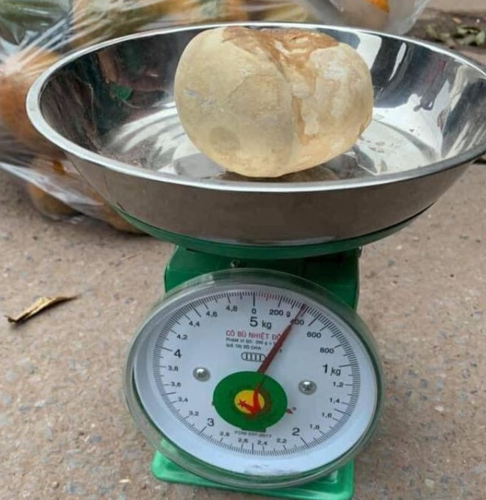 Sinistro: A pedra na bexiga Uma enorme pedra tirada da bexiga de um residente vietnamita Paranormal News 2 | Bizarro | bexiga, bizarro, doença, hospital, incrível, medico, pedra, rim