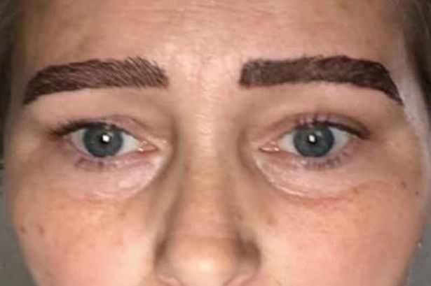 Sobrancelhas que não deram muito certo 1 Womans Botched Microblading Procedure Leaves Her With Monster BrowsMany people across the world | Bizarro | bizarro, esranho, estética, sobrancelha