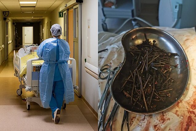Médicos retiram mais de 1kg de parafusos e porcas do estômago de um homem nuts and bolts2 | Bizarro | bizarro, estranho, grotesco, sinistro