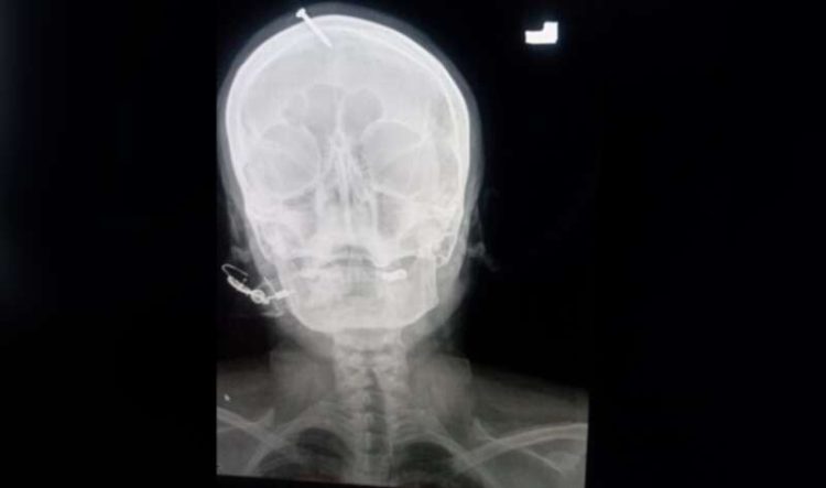 Mulher tem a cabeça pregada para garantir um filho "homi" e bem saudável skull nail3 750x443 1 | Bizarro | absurdo, bizarro, crendice, fé, paquistão
