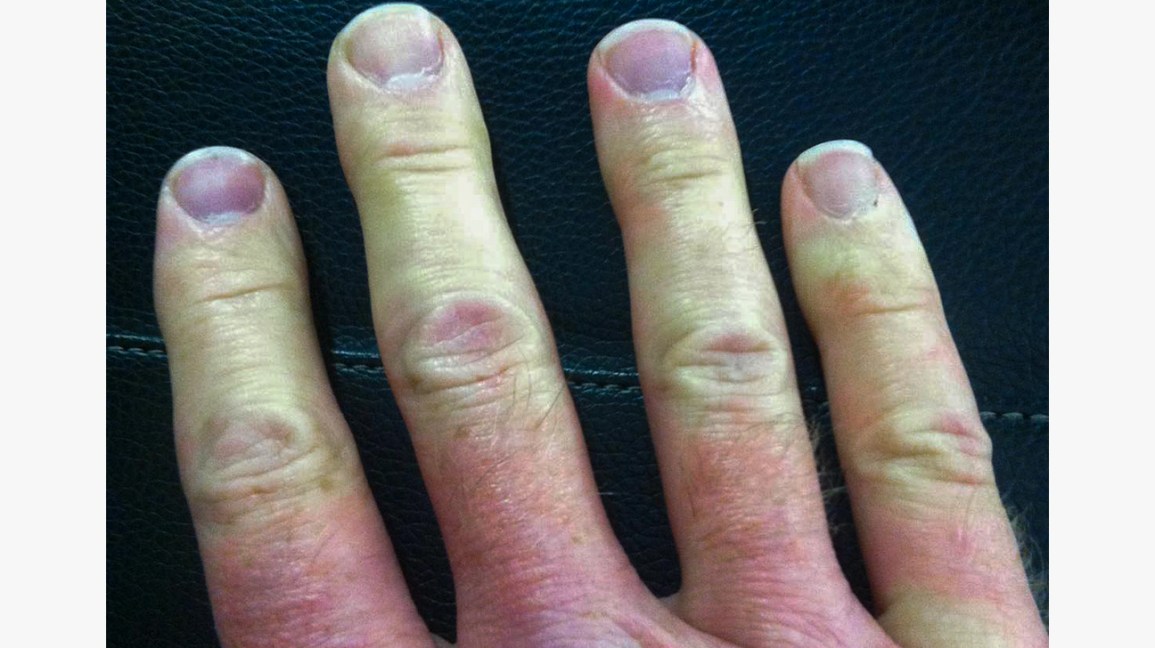 A doença bizarra que faz seus dedos ficarem brancos Raynauds phenomenon body1 | Bizarro | bizarro, doença, estranho