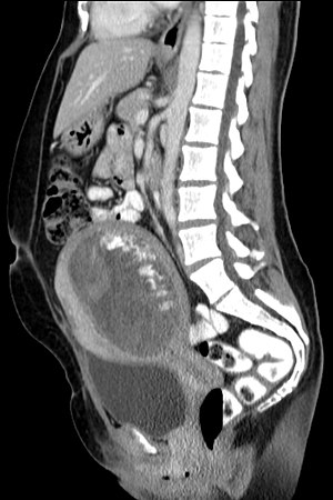 Foto Gump do dia: Grávida do alienígena Blasenmole Computertomographie sagittal | Bizarro | bizarro, foto gump do dia, sinistro