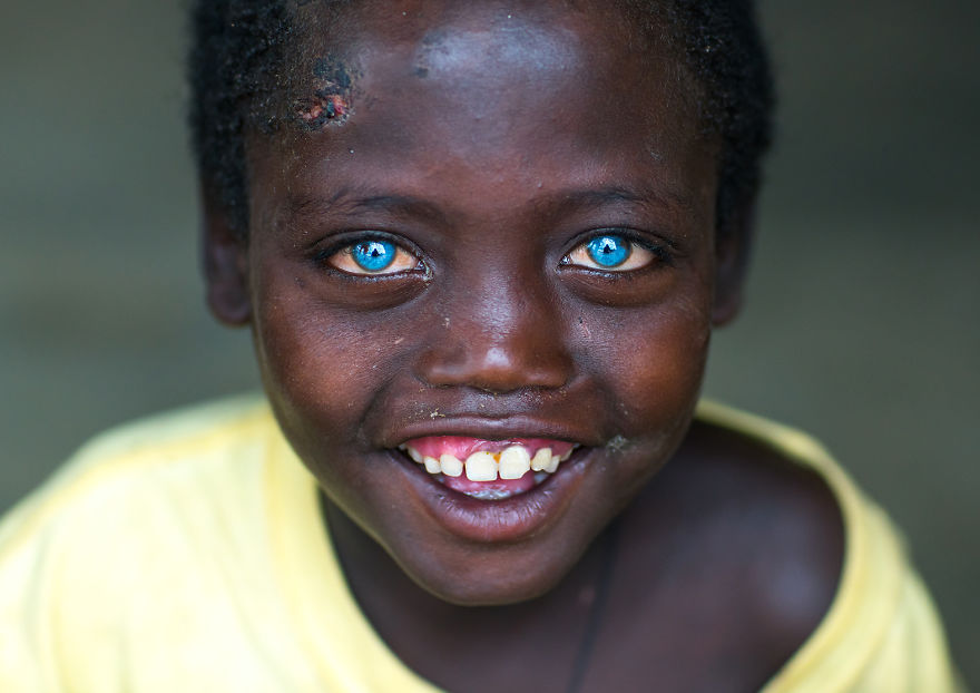 Cirurgia que muda a cor do olho: Saiba tudo ETHIO162195 589da597a15a3 880 | Curiosidades | ceratopigmentação, cirurgia, como ficar com o olho azul, curiosidades, dicas, olftalmologia, olho azul, olhos