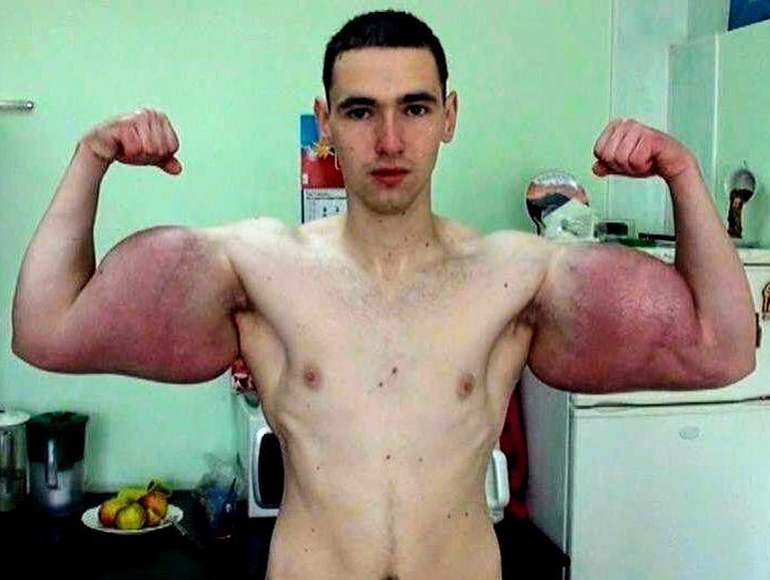 Os abusos do uso de Synthol causam deformidades Os abusos do uso de Synthol causam deformidades