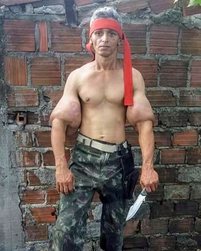 Os abusos do uso de Synthol causam deformidades Os abusos do uso de Synthol causam deformidades