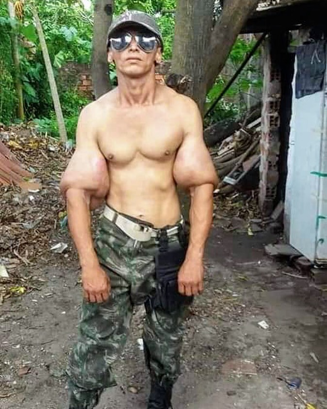Os abusos do uso de Synthol causam deformidades Os abusos do uso de Synthol causam deformidades