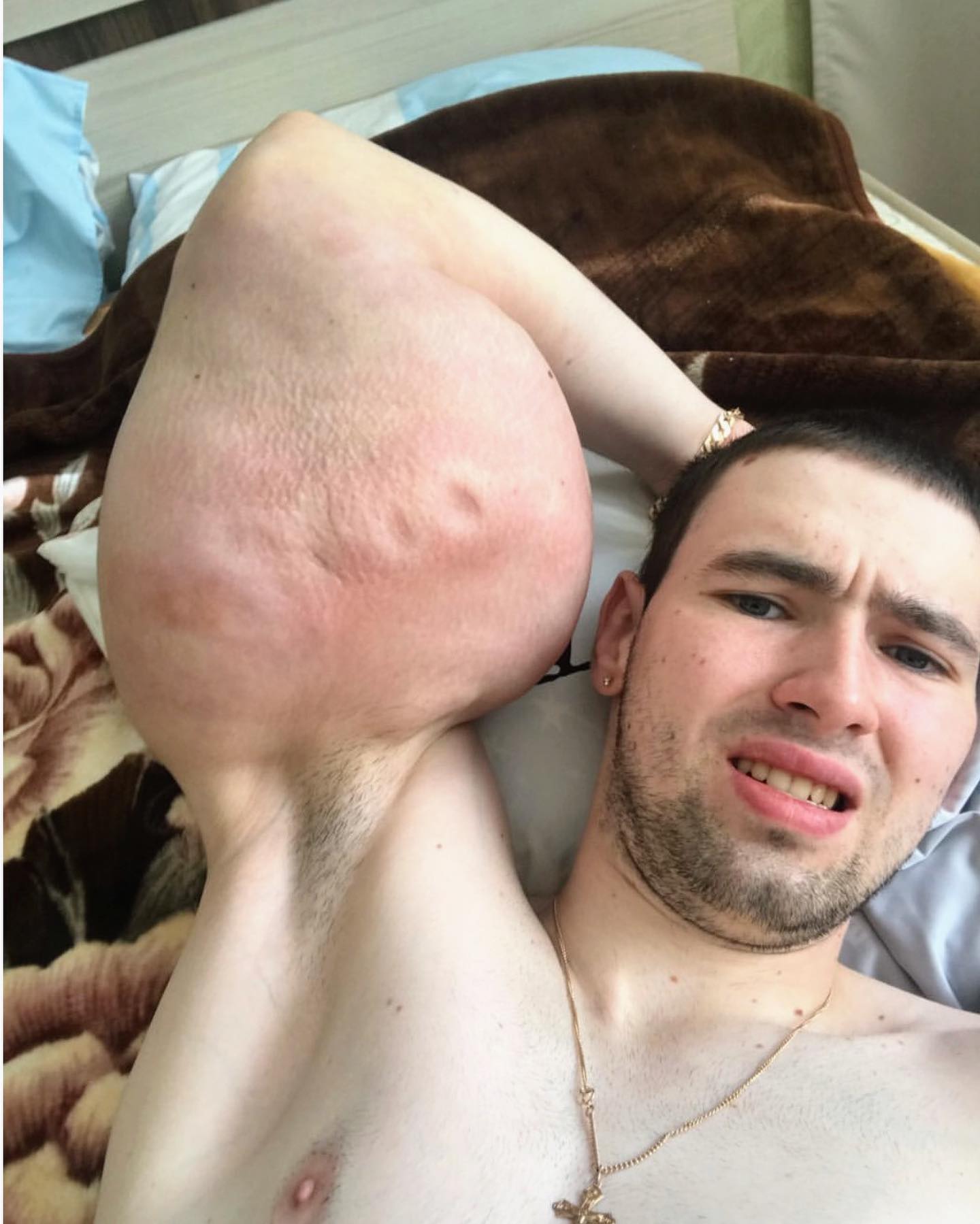 Os abusos do uso de Synthol causam deformidades Os abusos do uso de Synthol causam deformidades