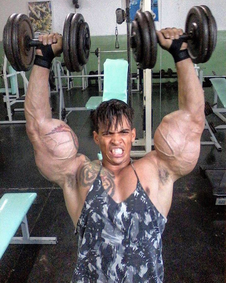 Os abusos do uso de Synthol causam deformidades Os abusos do uso de Synthol causam deformidades