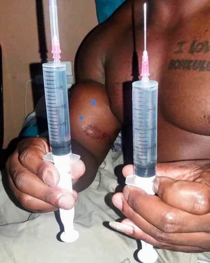 O Segredo do Synthol: Um Olhar Profundo sobre o Uso e Riscos Os abusos do uso de Synthol causam deformidades