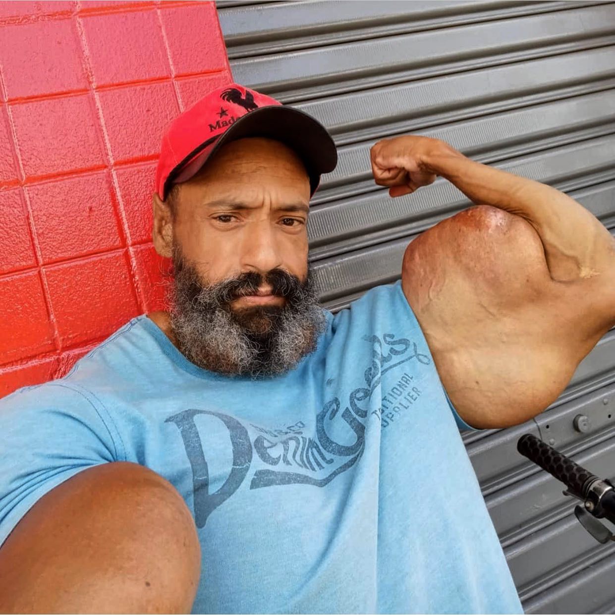 Os abusos do uso de Synthol causam deformidades Os abusos do uso de Synthol causam deformidades