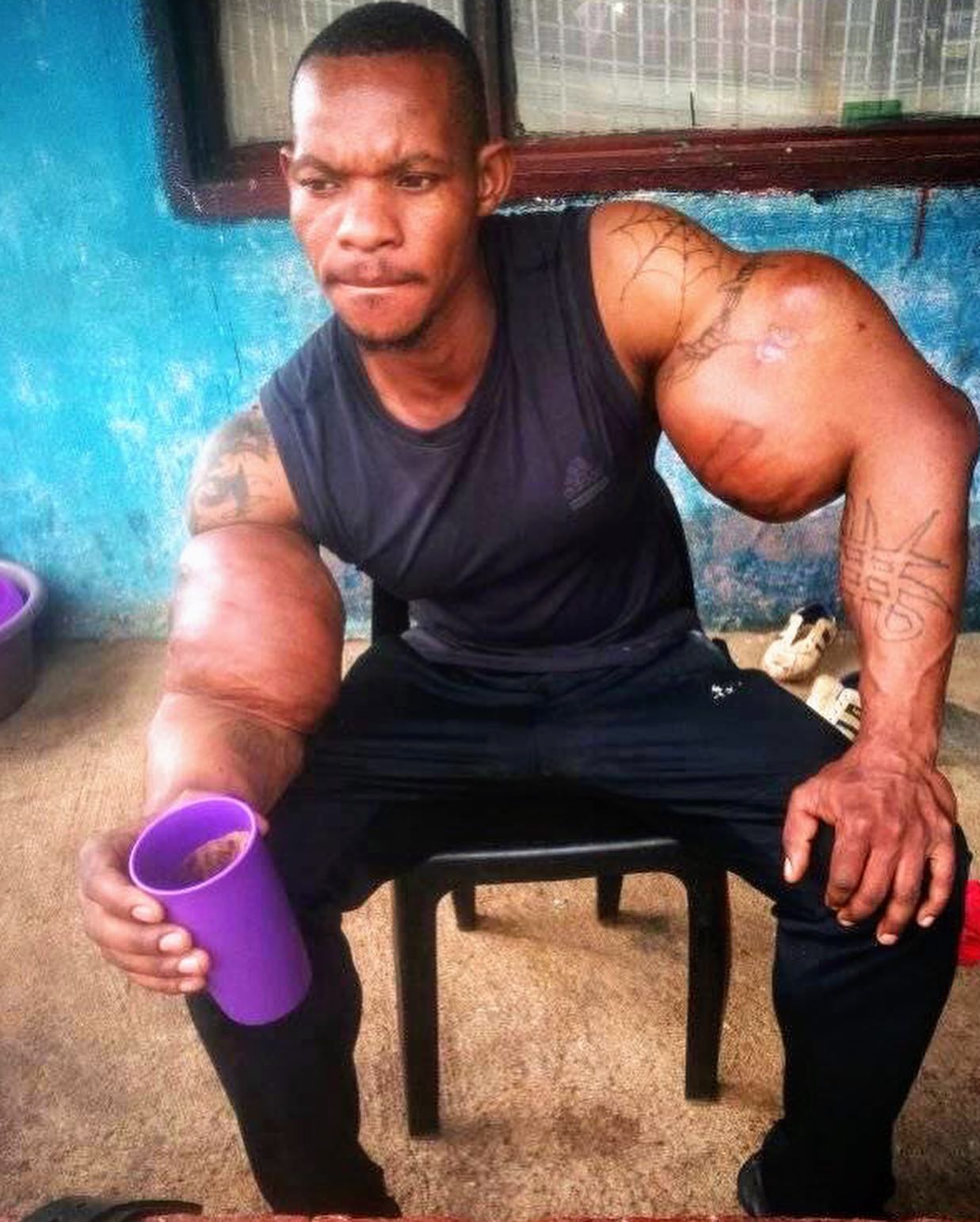 Os abusos do uso de Synthol causam deformidades Os abusos do uso de Synthol causam deformidades