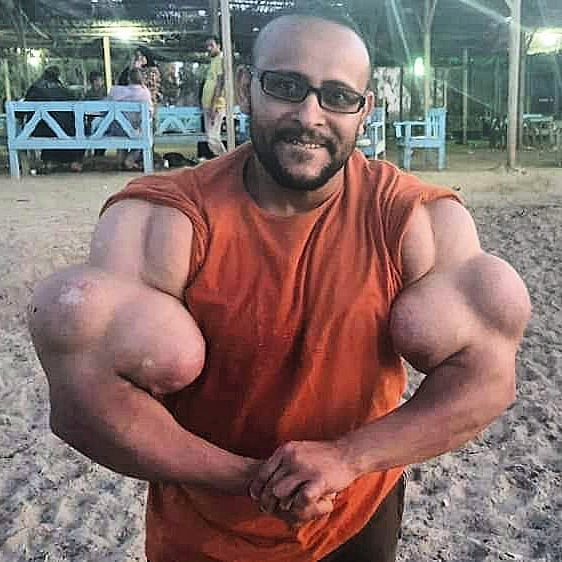 Os abusos do uso de Synthol causam deformidades Os abusos do uso de Synthol causam deformidades