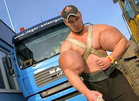 Os abusos do uso de Synthol causam deformidades Os abusos do uso de Synthol causam deformidades