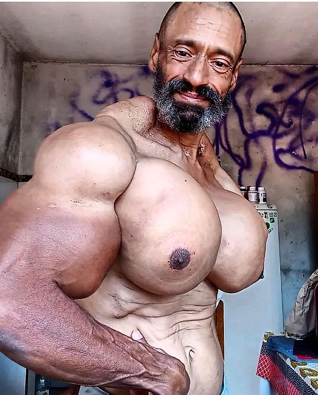 Os abusos do uso de Synthol causam deformidades Os abusos do uso de Synthol causam deformidades