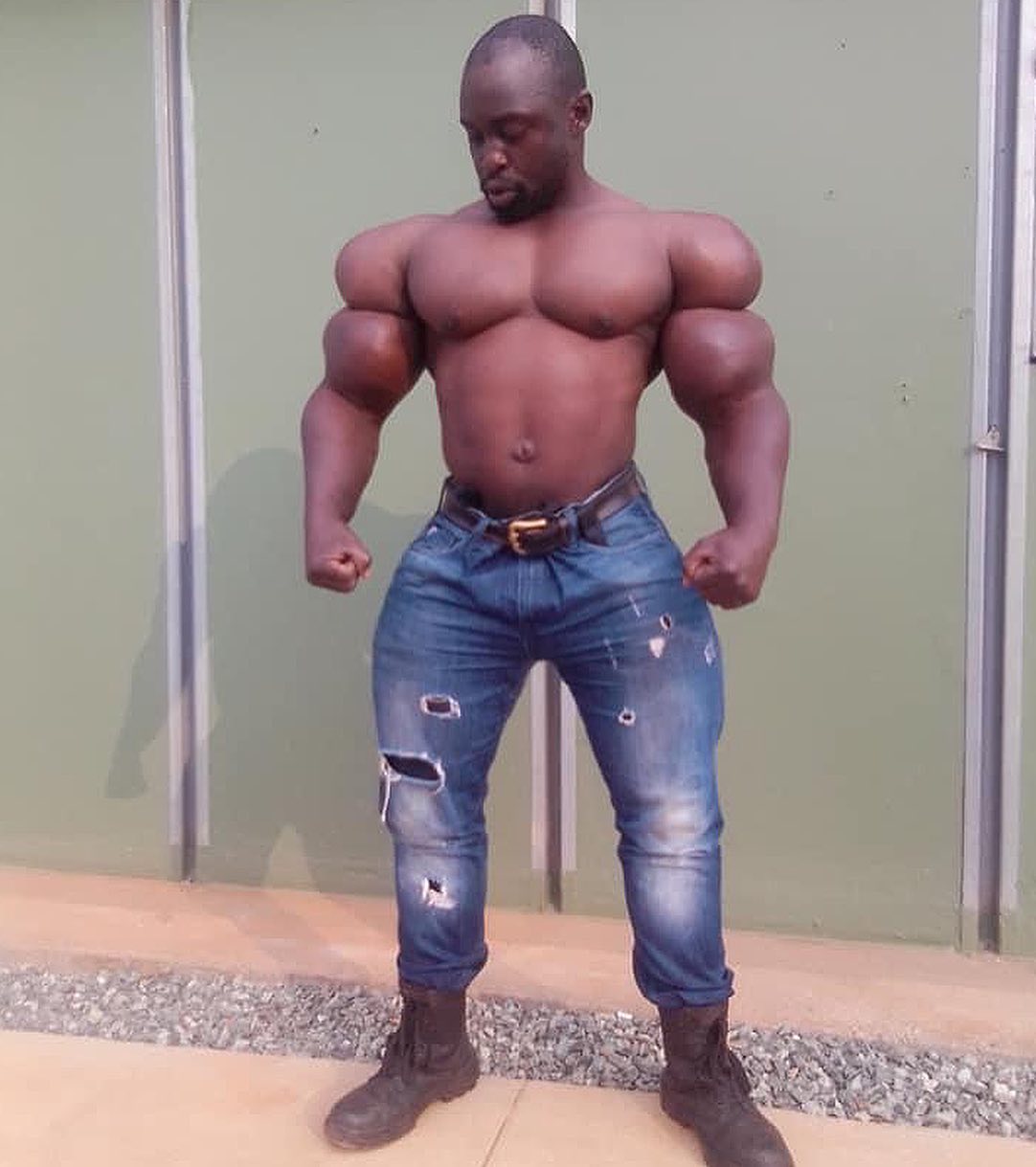 Os abusos do uso de Synthol causam deformidades Os abusos do uso de Synthol causam deformidades