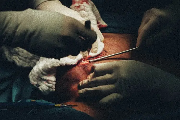 HISASHI OUCHI: a pessoa que tomou mais radiação no mundo e viveu por 83 dias Cancer surgery.jpg | Bizarro | bizarro, curiosidades, japão, radiação