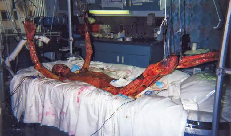 HISASHI OUCHI: a pessoa que tomou mais radiação no mundo e viveu por 83 dias Hisashi Ouchi Tokaimura Nuclear Accident 4.jpg | Bizarro | bizarro, curiosidades, japão, radiação