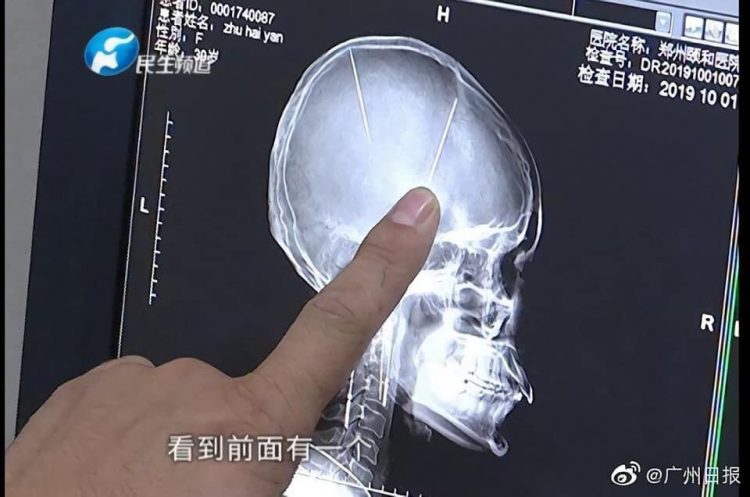 Mulher descobre que tem uma agulha enfiada no cérebro, e isso nem é o pior brain needles 750x497 1 | Bizarro | agulha, bizarro, cerebro, china, morte, russia