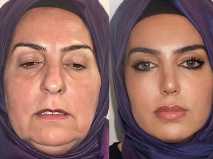 Clínica de cirurgia plástica se torna viral após "antes e depois" inacreditável Este Med plastic surgery3 | Incrível | bizarro, cirurgia, incrível, plastica