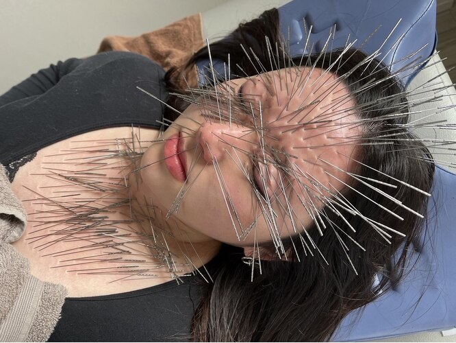 Técnica de acupuntura que te transforma num porco espinho acupuncture6 | Curiosidades | acupuntura, japão