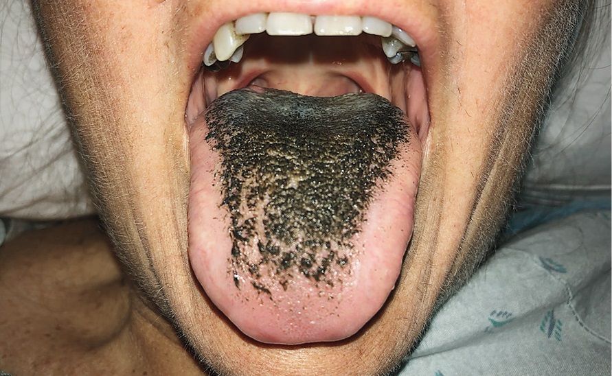 É verdade que algumas pessoas tem tentáculos na língua? lingua peluda preta