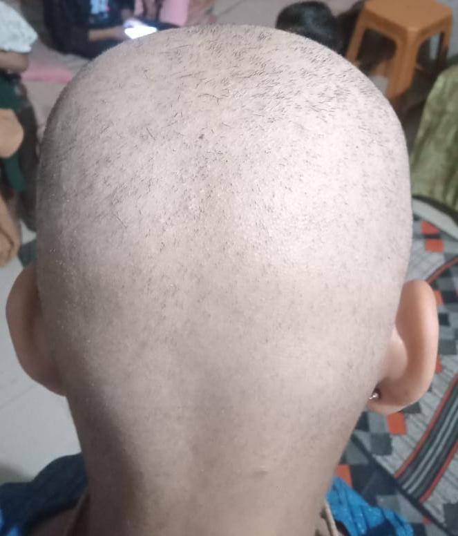 Vírus da careca assusta a Índia: A pessoa fica calva em 3 dias O Virus da careca segue causando estragos na Índia