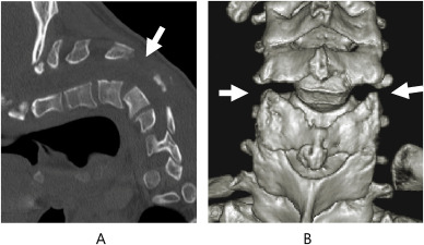 Problema de coluna: De tanto olhar o celular, deu ruim 1 s2.0 S2772964823000369 gr2 | Bizarro | alerta postural, coluna cervical, deformidade cervical, dores no pescoço., má postura, postura correta, problemas na coluna, saúde da coluna, síndrome da cabeça caída, uso excessivo do celular