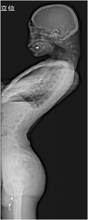 Problema de coluna: De tanto olhar o celular, deu ruim 1 s2.0 S2772964823000369 gr3 | Bizarro | alerta postural, coluna cervical, deformidade cervical, dores no pescoço., má postura, postura correta, problemas na coluna, saúde da coluna, síndrome da cabeça caída, uso excessivo do celular