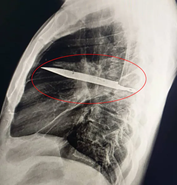 Oito anos com uma faca enterrada no peito e não sabia knife blade | Bizarro | bizarro, faca, medicina